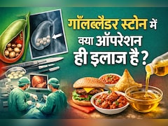 गॉल ब्लैडर में पथरी है? क्या Gallbladder निकालना ही एक मात्र रास्ता है... यहां हैं दूसरे ऑप्शन
