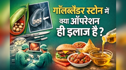 गॉल ब्लैडर में पथरी है? क्या Gallbladder निकालना ही एक मात्र रास्ता है... यहां हैं दूसरे ऑप्शन