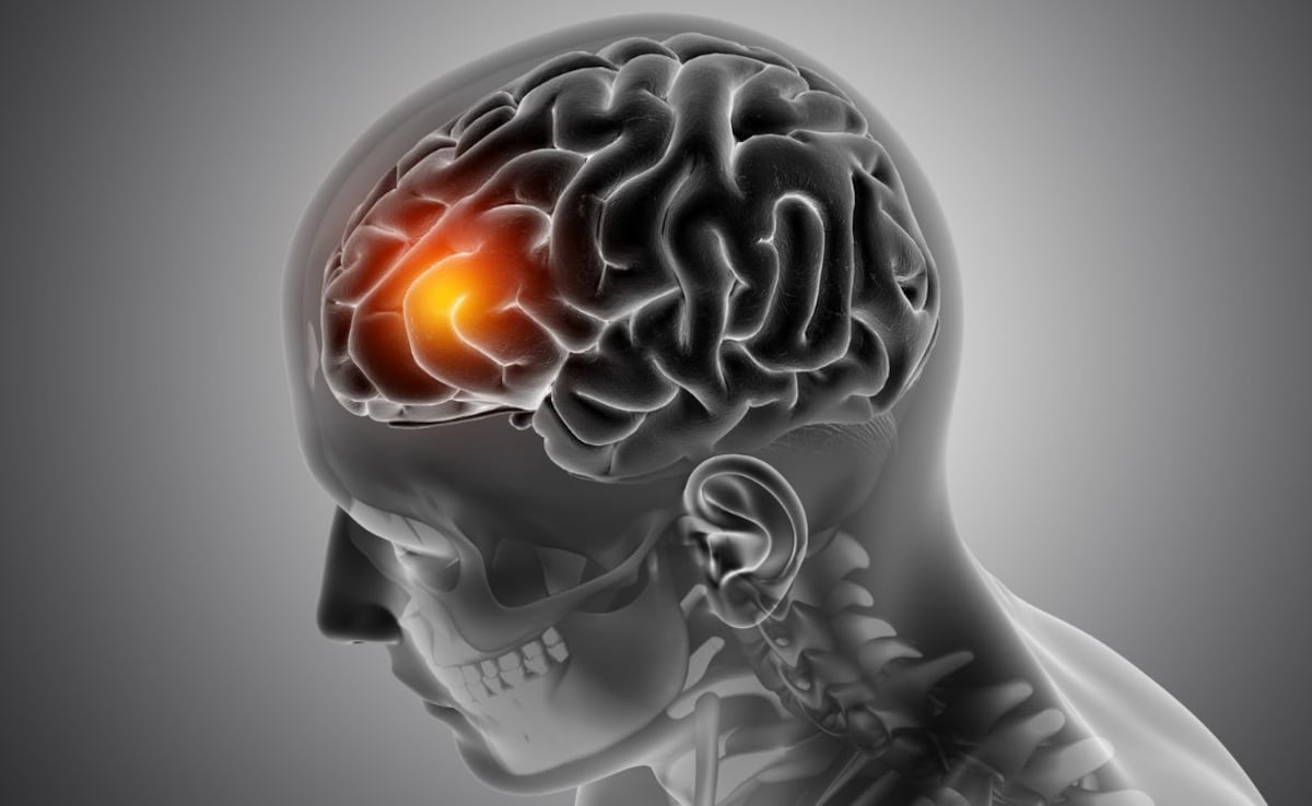 Meningitis Outbreak UK: 2 Students Die, Several Others Infected; What You Need To Know About The Infection