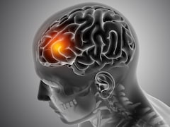 Meningitis Outbreak UK: 2 Students Die, Several Others Infected; What You Need To Know About The Infection