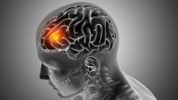 Meningitis Outbreak UK: 2 Students Die, Several Others Infected; What You Need To Know About The Infection