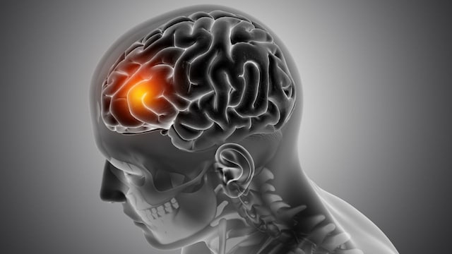 Meningistis causes inflammation of the tissues surrounding the brain and spinal cord