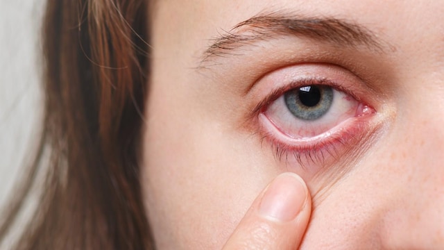 A blood spot in the eye, often a subconjunctival hemorrhage