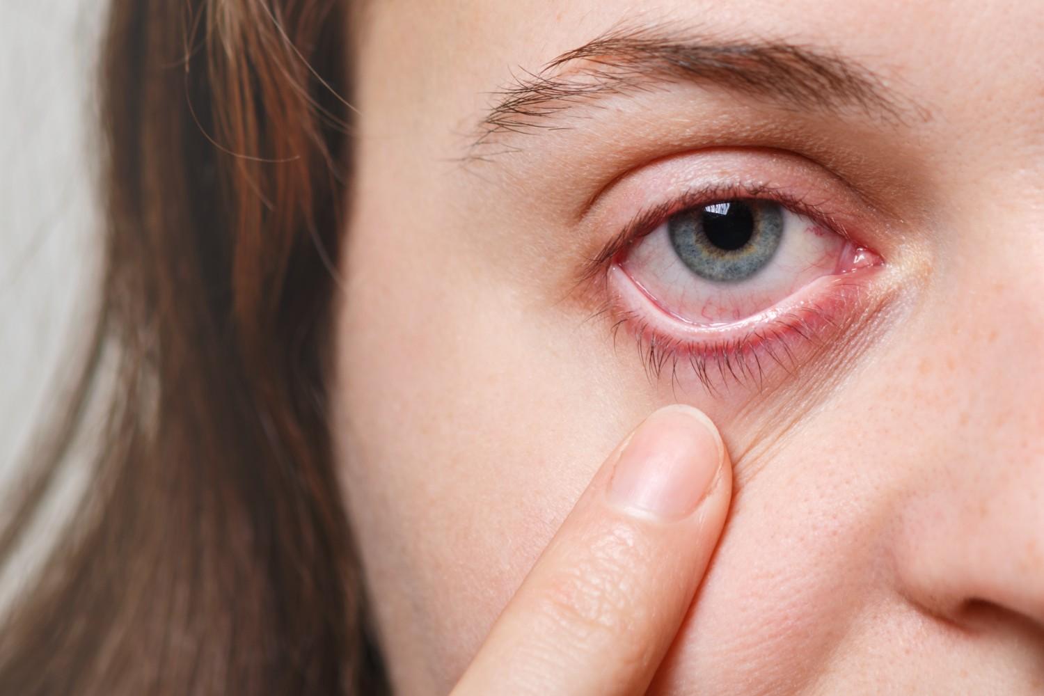 A blood spot in the eye, often a subconjunctival hemorrhage