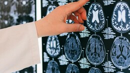 Study Finds Smoking Weed And Tobacco Accelerates Brain Shrinkage