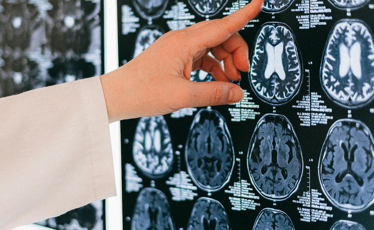 Study Finds Smoking Weed And Tobacco Accelerates Brain Shrinkage