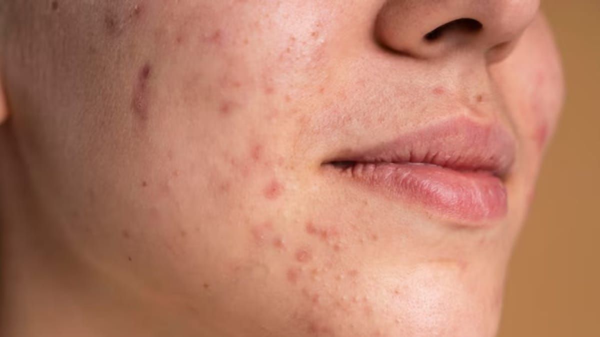 Why Your Skin Gets Sensitive In Spring, Dietitian Explains How To Deal With It