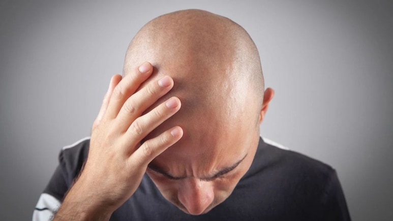 Male Pattern Baldness Caused By Gut Health? New Study Finds Surprising Link