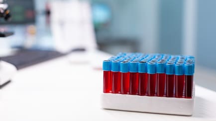 American Heart Association Releases Cholesterol Management Guidelines