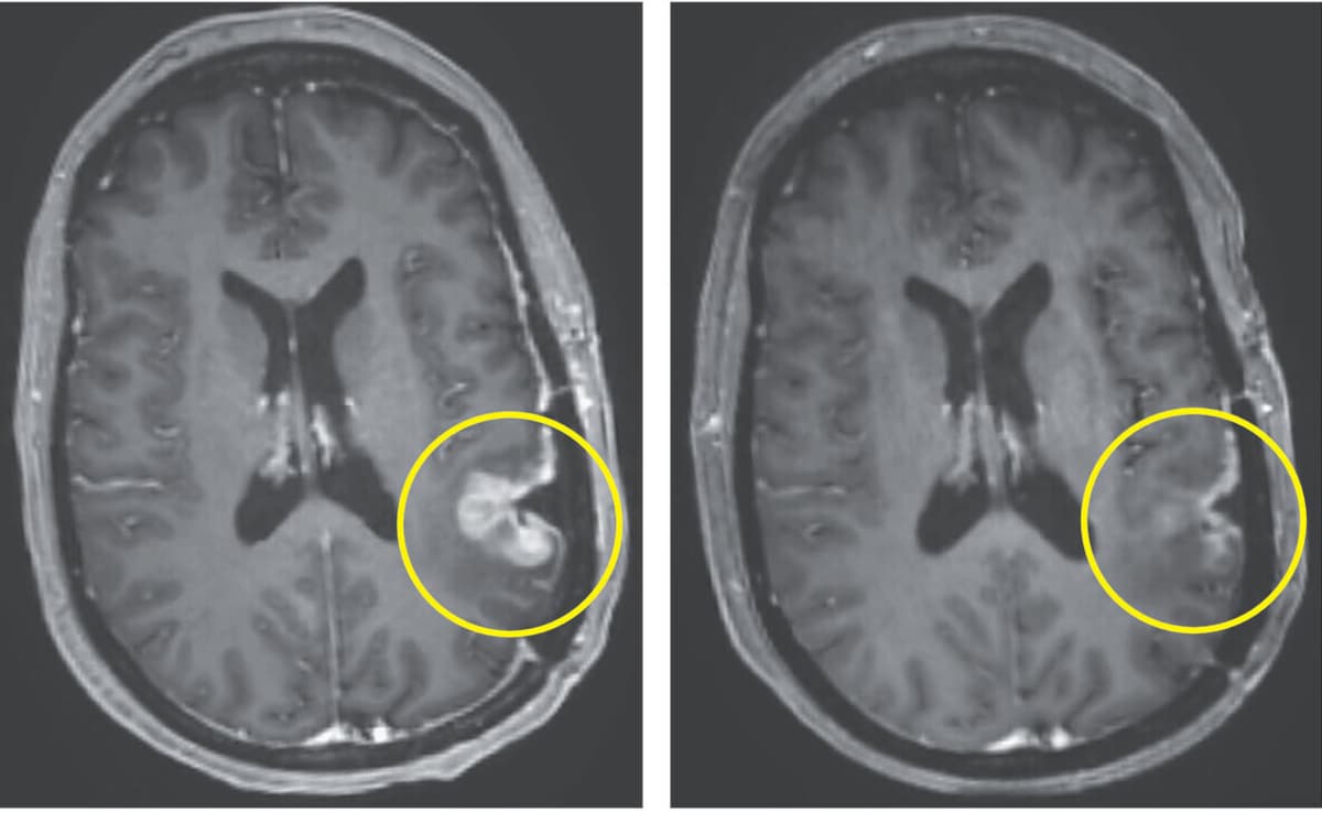 Breakthrough Brain Cancer Therapy Shows Dramatic Tumour Shrinking In 5 Days In Early Trial