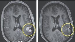 Breakthrough Brain Cancer Therapy Shows Dramatic Tumour Shrinking In 5 Days In Early Trial