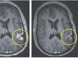 Breakthrough Brain Cancer Therapy Shows Dramatic Tumour Shrinking In 5 Days In Early Trial