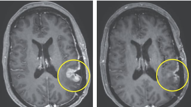 CAR-T Therapy for brain tumour