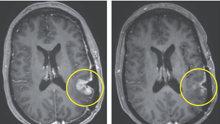 Breakthrough Brain Cancer Therapy Shows Dramatic Tumour Shrinking In 5 Days In Early Trial