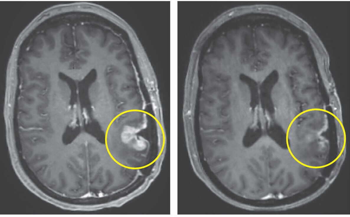 CAR-T Therapy for brain tumour