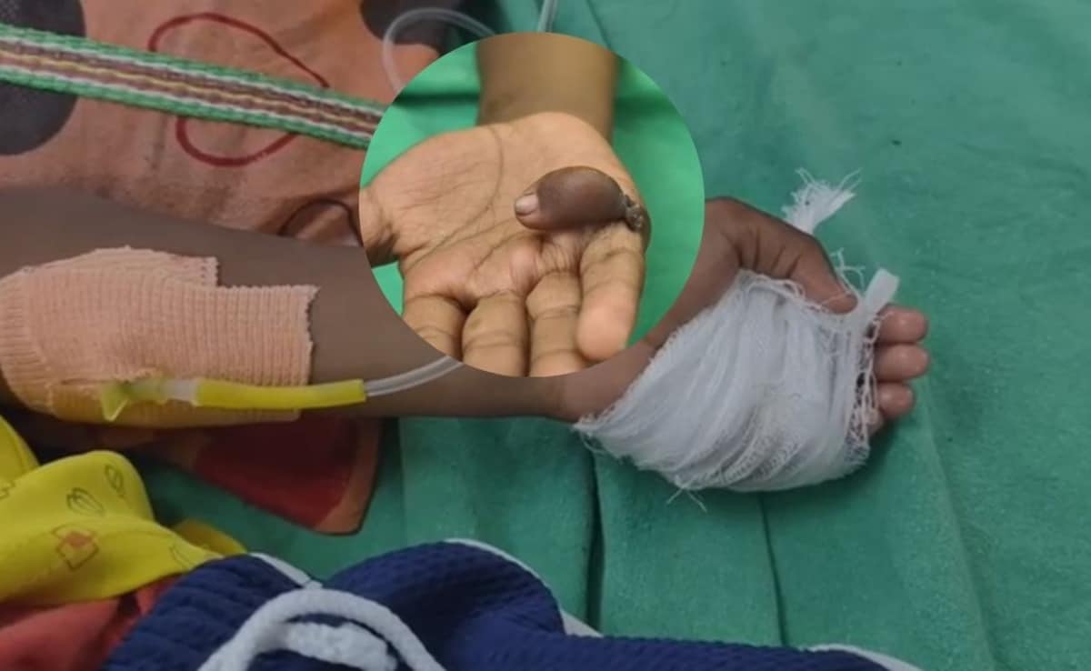 ये क्या कर दिया ! महाराष्ट्र के अस्पताल में मासूम की सर्जरी में चूक, डॉक्टर ने निकाल दी गलत हाथ की उंगली