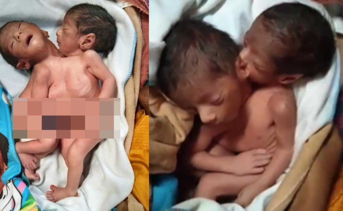 कंज्वाइंट ट्विंस... 2 सिर, 2 हाथ और 4 पैर, पर दिल एक, जन्म के बाद मां की मौत; बच्चे दूध पी रहे, मामला चौंका देगा  