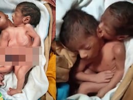 2 सिर, 2 हाथ और 4 पैर, पर दिल एक, जन्म के बाद मां की मौत; बच्चे दूध पी रहे, मामला चौंका देगा &nbsp;