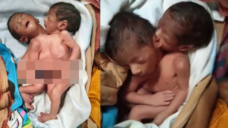 2 सिर, 2 हाथ और 4 पैर, पर दिल एक, जन्म के बाद मां की मौत; बच्चे दूध पी रहे, मामला चौंका देगा &nbsp;