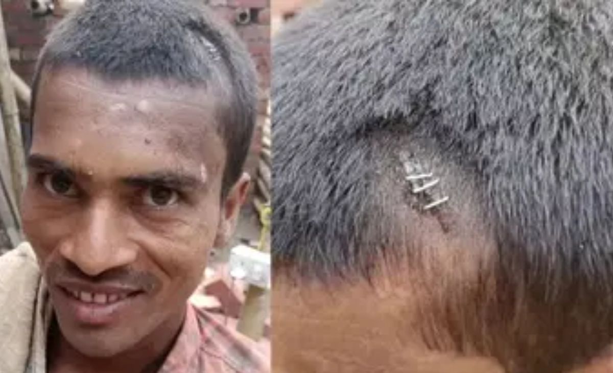 बिहार के युवक का सिर फटने पर स्टेपलर पिन मारने के वायरल वीडियो की सच्चाई