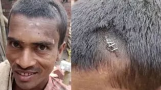बिहार के युवक का सिर फटने पर स्टेपलर पिन मारने के वायरल वीडियो की सच्चाई