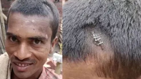बिहार के युवक का सिर फटने पर स्टेपलर पिन मारने के वायरल वीडियो की सच्चाई