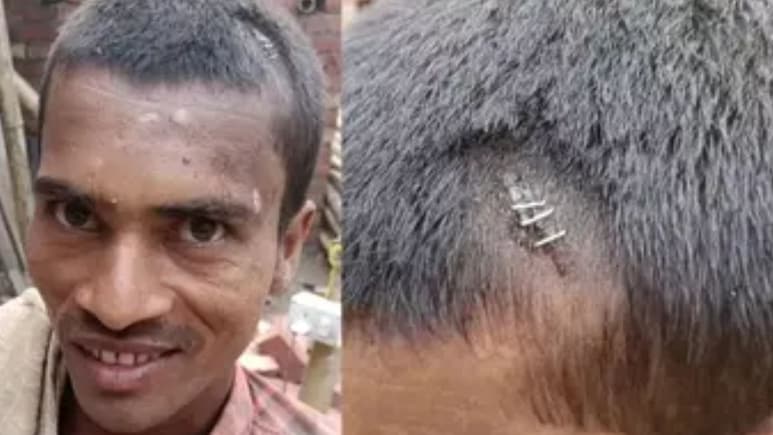 बिहार के युवक का सिर फटने पर स्टेपलर पिन मारने के वायरल वीडियो की सच्चाई