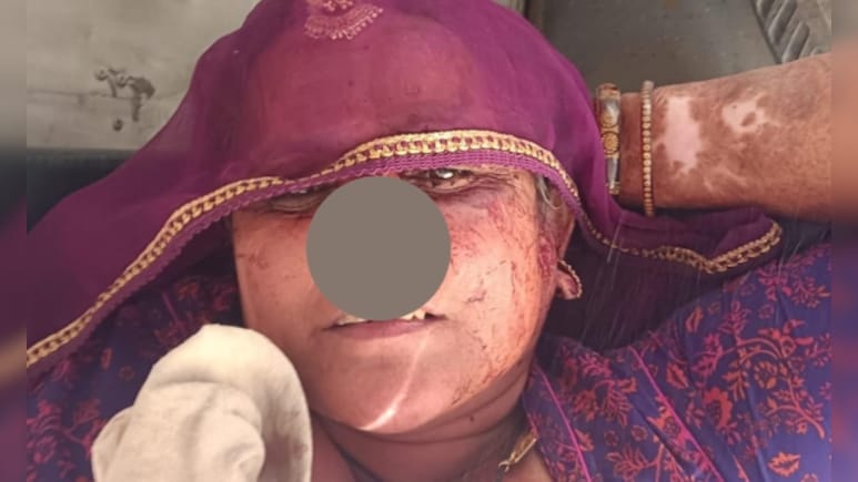 सांचौर में सनसनीखेज वारदात सास से नाराज दामाद ने कैंची से काट दी नाक, कटा हिस्सा लेकर हुआ फरार&nbsp;