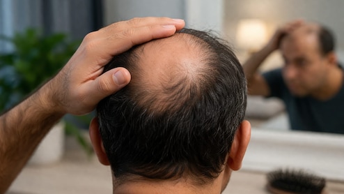 गंजेपन के पैच ने बढ़ाई चिंता? ये 5 आसान नुस्खे दे सकते हैं राहत