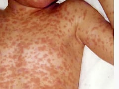 बांग्लादेश में खसरा संकट: 1 महीने में बच्चों की मौत का आंकड़ा 194 पहुंचा, संदिग्ध बच्चों की संख्या 28,000