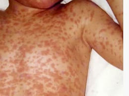 बांग्लादेश में खसरा संकट: 1 महीने में बच्चों की मौत का आंकड़ा 194 पहुंचा, संदिग्ध बच्चों की संख्या 28,000