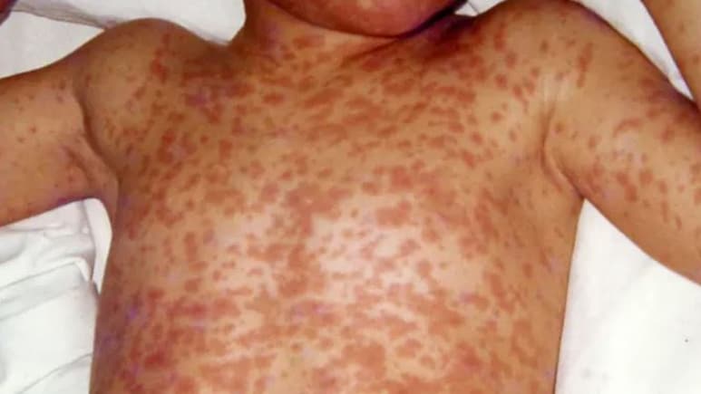 बांग्लादेश में खसरा संकट: 1 महीने में बच्चों की मौत का आंकड़ा 194 पहुंचा, संदिग्ध बच्चों की संख्या 28,000