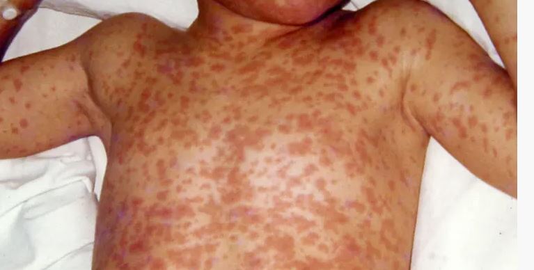 Measles outbreak in Utah has been tough to contain to one region