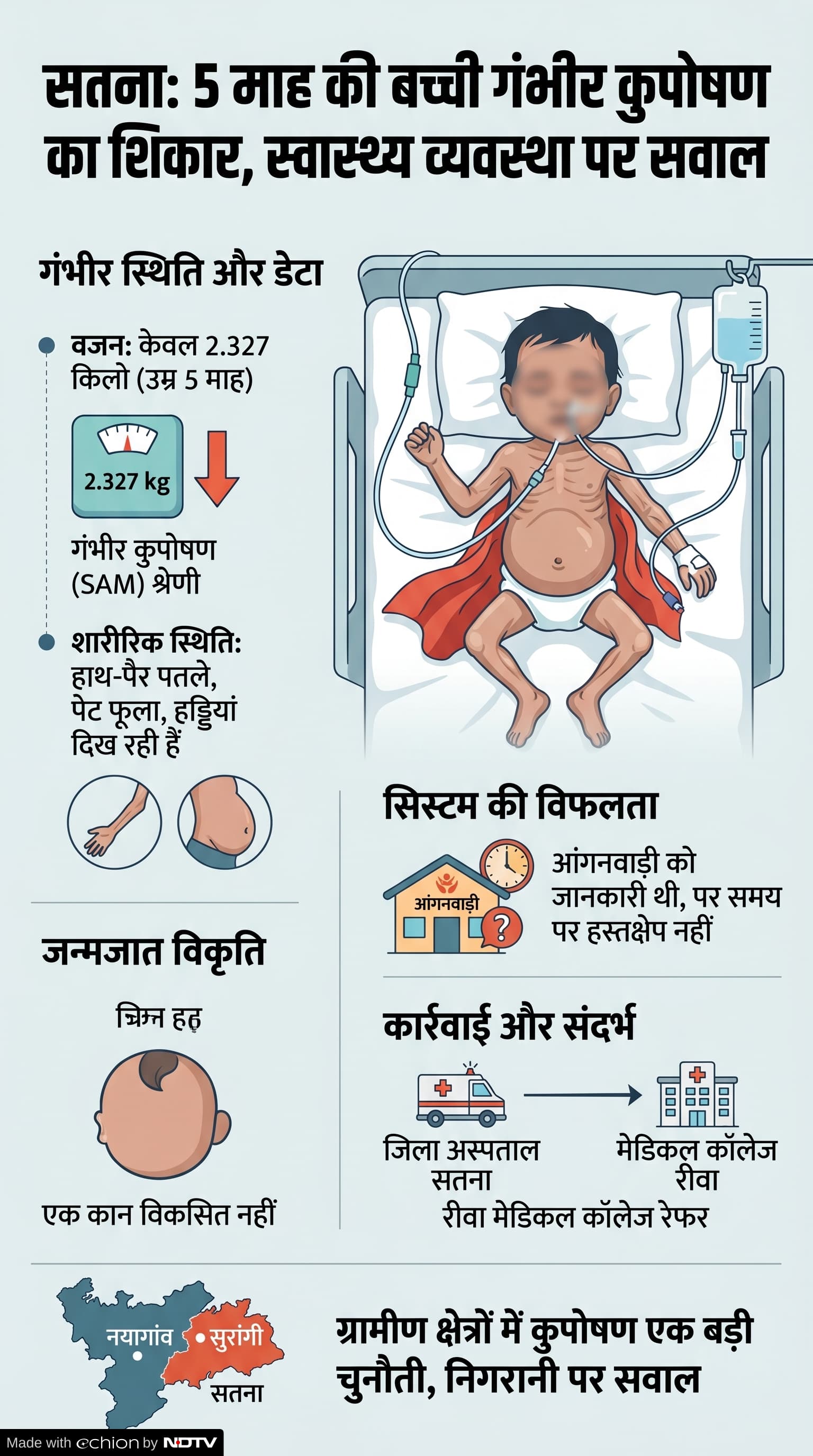 Malnutrition Case: सतना कुपोषण मामला