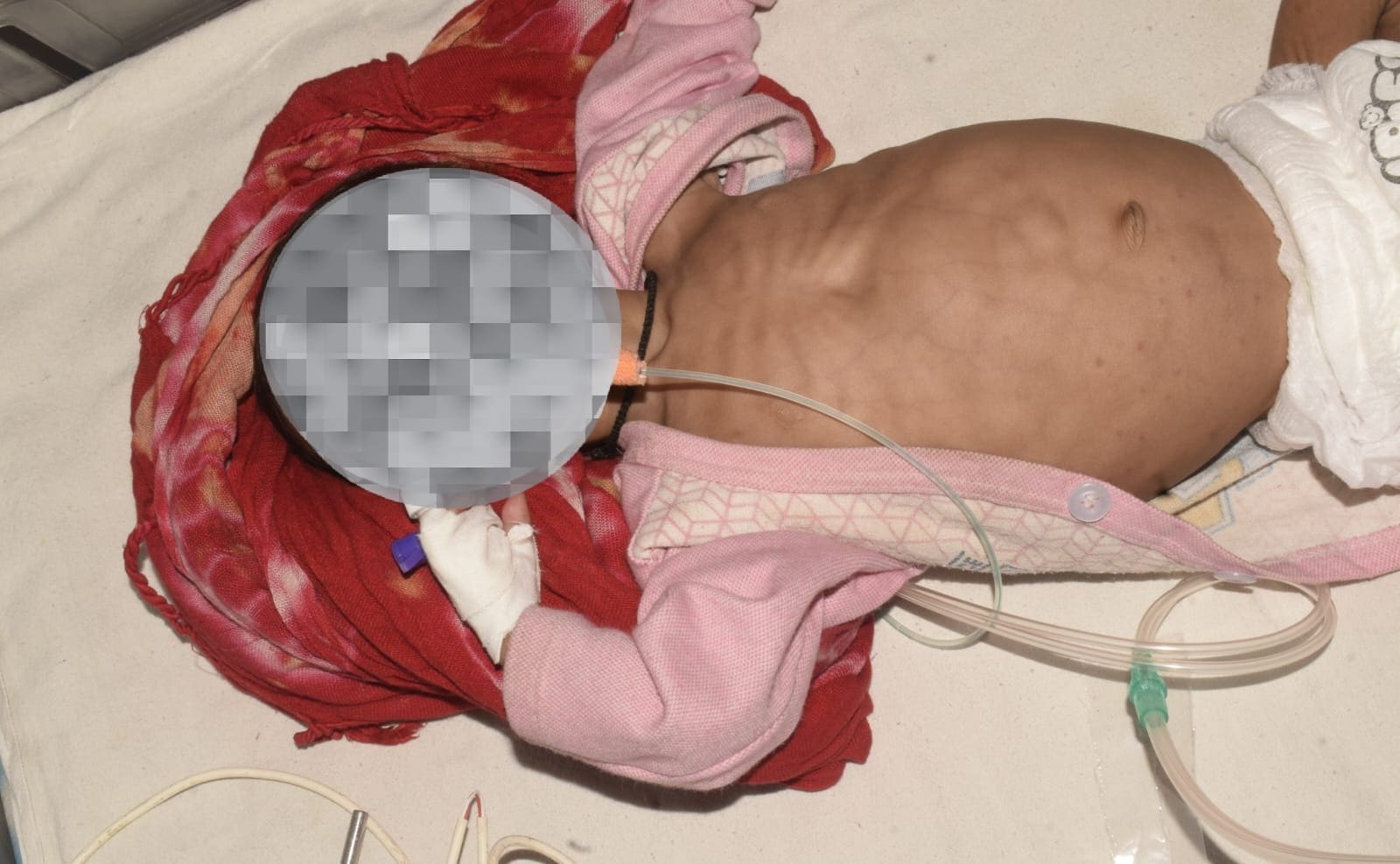 Malnutrition Case: नयागांव कुपोषित बच्ची