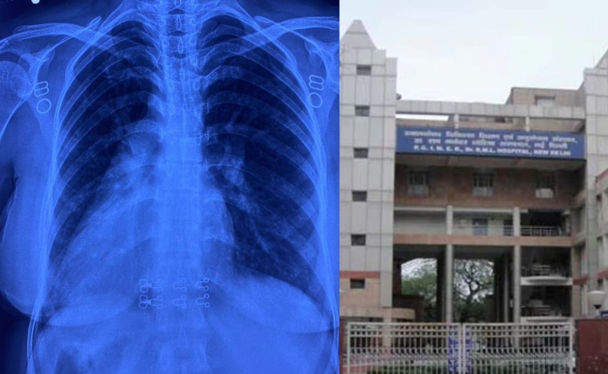 दिल ही नहीं लिवर और बाकी अंग भी थे उलटे, छाती की हड्डी काटे बिना दिल्ली के डॉक्टरों ने कर दी सफल सर्जरी