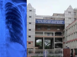 दिल ही नहीं लिवर और बाकी अंग भी थे उलटे, छाती की हड्डी काटे बिना दिल्ली के डॉक्टरों ने कर दी सफल सर्जरी