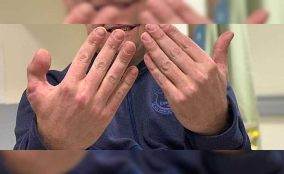 गजब की सर्जरी! डॉक्टर्स ने हाथ में लगा दिया पैर का अंगूठा, अब देखिये नतीजा...