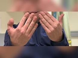 गजब की सर्जरी! डॉक्टर्स ने हाथ में लगा दिया पैर का अंगूठा, अब देखिये नतीजा...