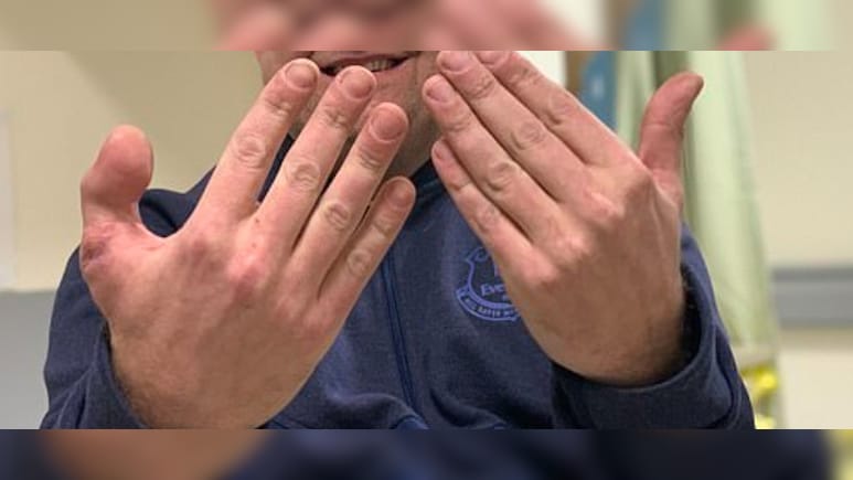 गजब की सर्जरी! डॉक्टर्स ने हाथ में लगा दिया पैर का अंगूठा, अब देखिये नतीजा...