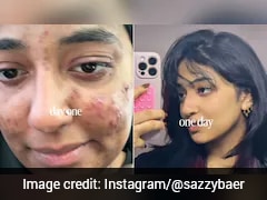 दुबई की 23 साल की लड़की का Acne Transformation वायरल, बिना दवा सिर्फ 2 बदलाव से बदल गई स्किन