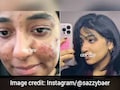 दुबई की 23 साल की लड़की का Acne Transformation वायरल, बिना दवा सिर्फ 2 बदलाव से बदल गई स्किन