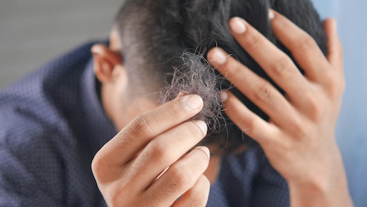 सिर के खाली हिस्सों पर फिर से उग सकते हैं बाल, अपनाएं ये असरदार घरेलू नुस्खे, कुछ ही दिनों में दिखने लगेगा असर