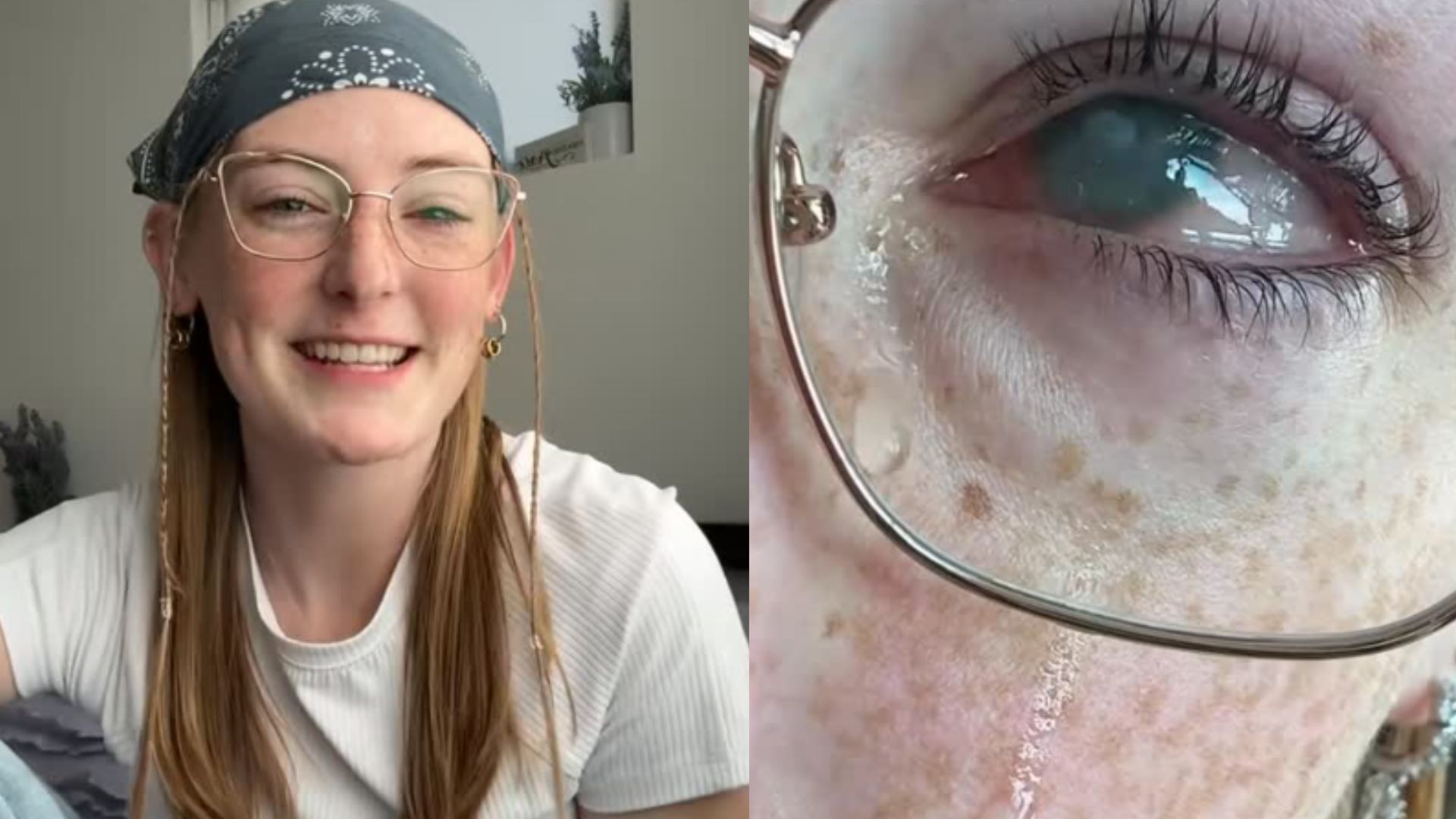A 20-Year-Old Woman Wore Contact Lenses To The Shower. She Went Blind