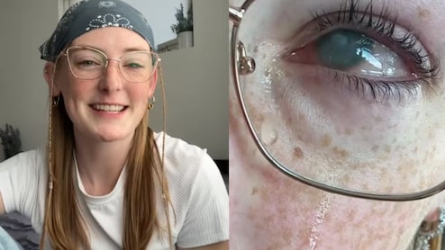 A 20-Year-Old Woman Wore Contact Lenses To The Shower. She Went Blind