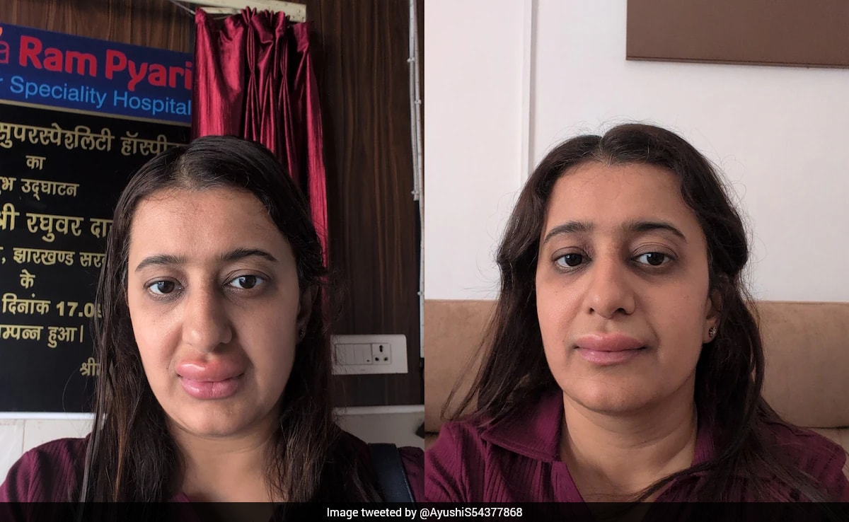 Woman Claims Food On Vande Bharat Triggered Allergy, IRCTC Says Inspection Found Meal "Satisfactory"