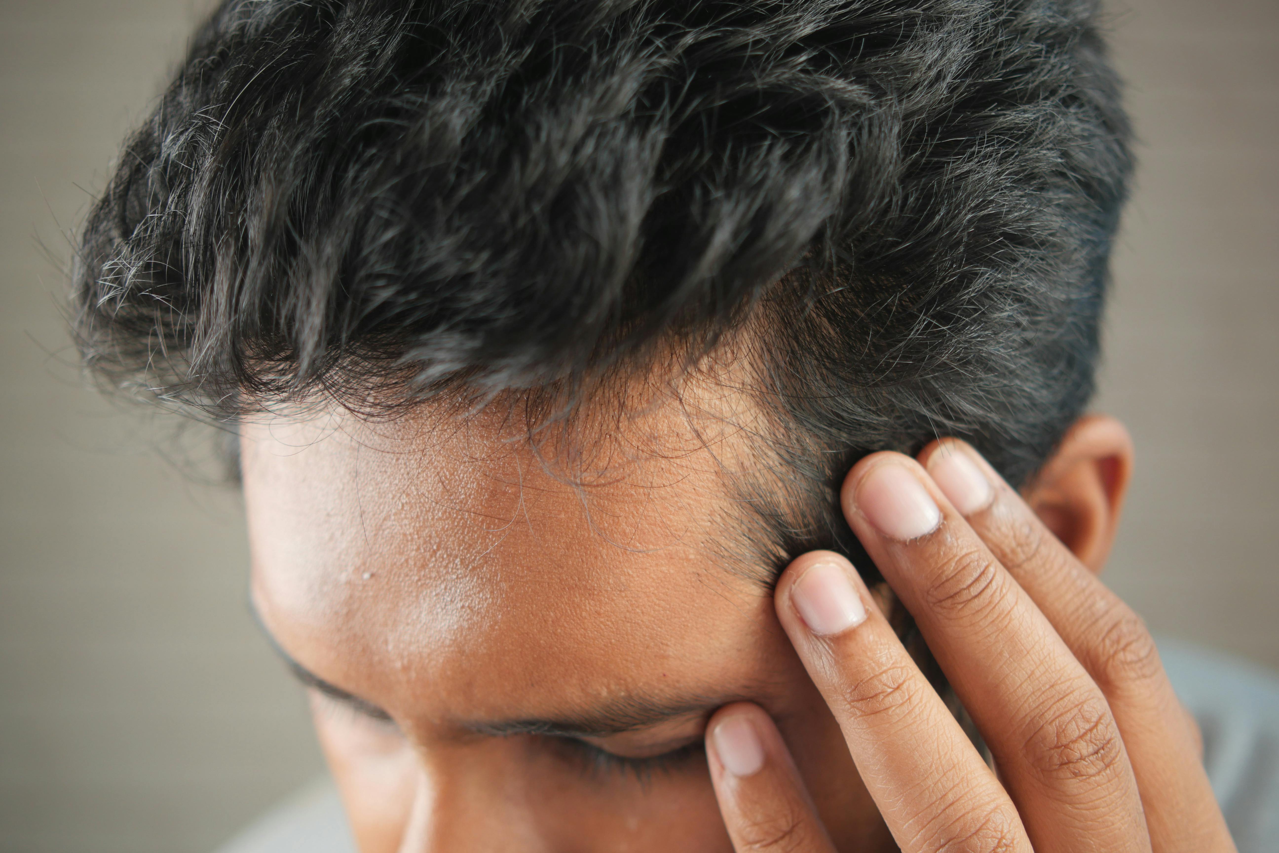 A receding hairline, on the other hand, is often an early sign of androgenetic alopecia