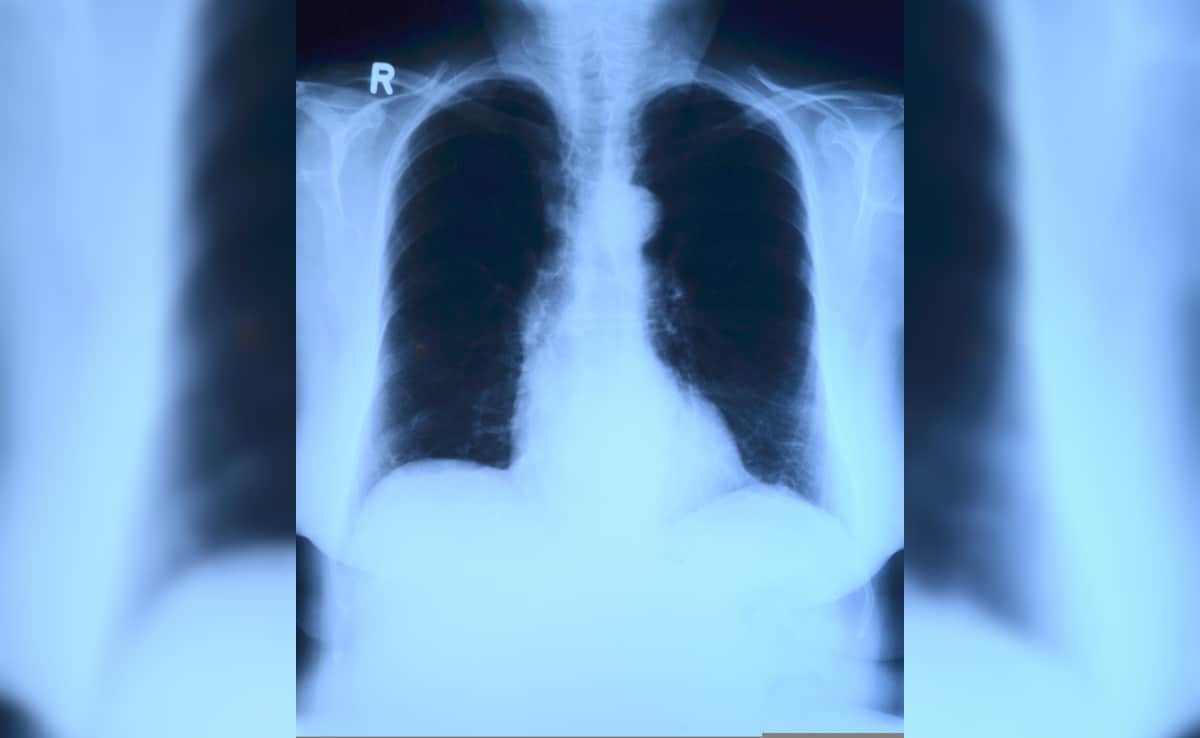 AI May Be Guessing X-Ray Results, Not Reading Them: Study