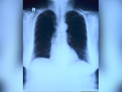 AI May Be Guessing X-Ray Results, Not Reading Them: Study