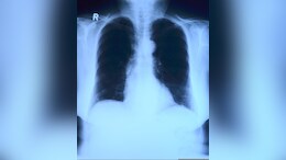 AI May Be Guessing X-Ray Results, Not Reading Them: Study